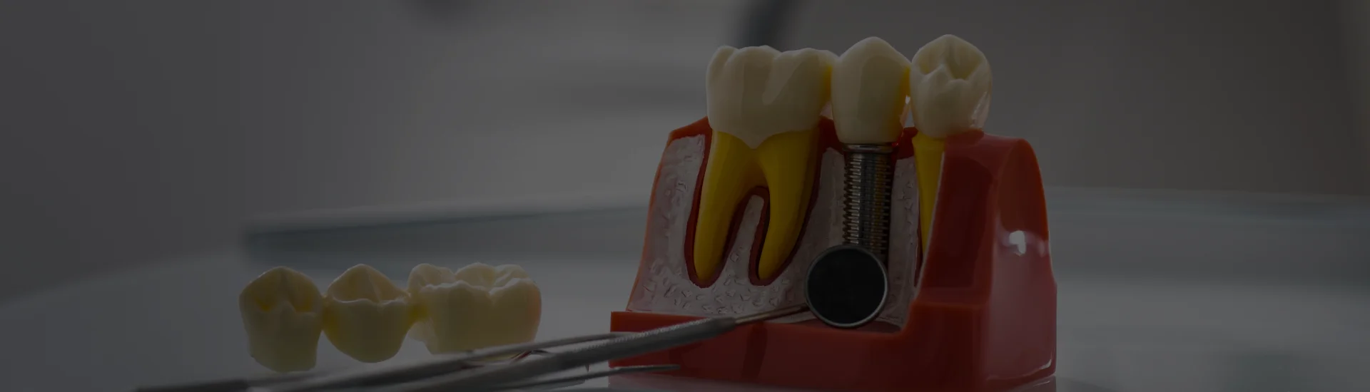 Dental Implants
