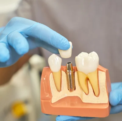 Dental Implants