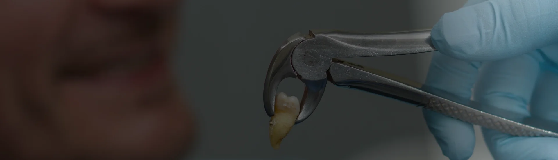 Tooth Extractions