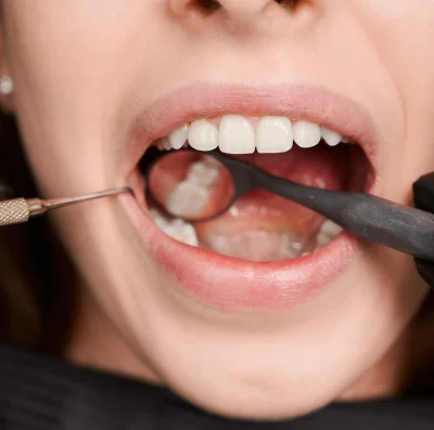 Tooth Extractions