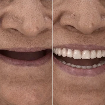 Smile Restoration with Complete Aesthetic Enhancement