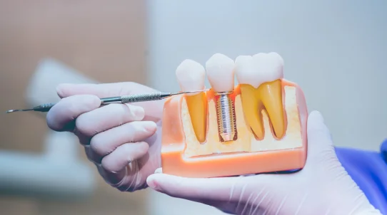 implant-benefits