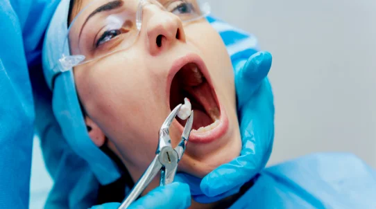 Tooth Extractions-benefits
