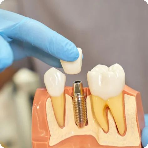 Dental Implants