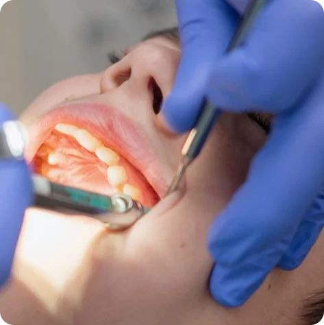 Tooth Extractions