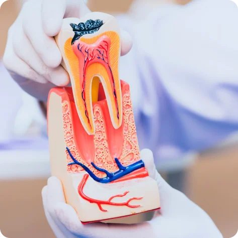Root Canal Treatment