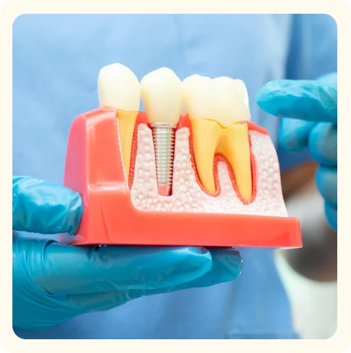 Dental Implants