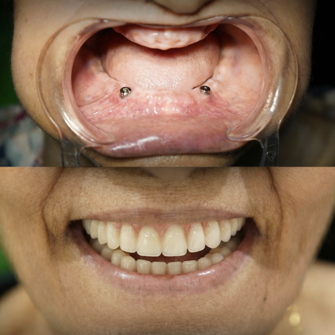 Full Mouth Rehabilitation with Implant-Supported Prosthesis