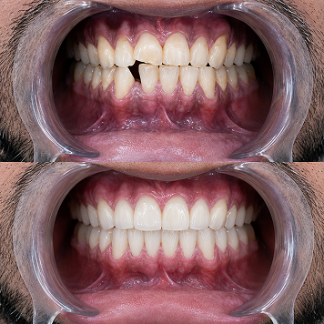 Functional Smile Rehabilitation with Aesthetic Restoration