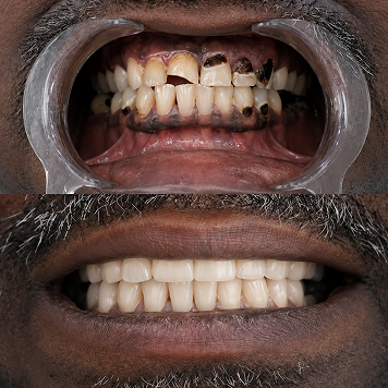 Comprehensive Smile Rehabilitation with Aesthetic Precision