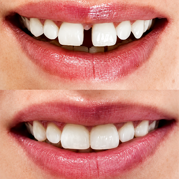 Diastema Closure with Composite Bonding