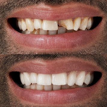 Smile Design