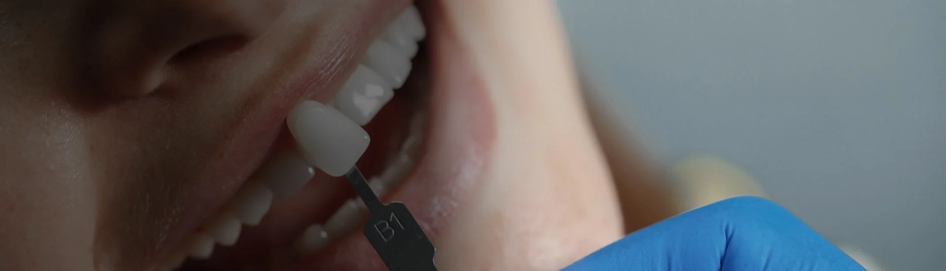 Veneers