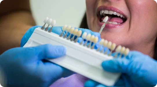 Veeners (Treatment Benefits Overview)