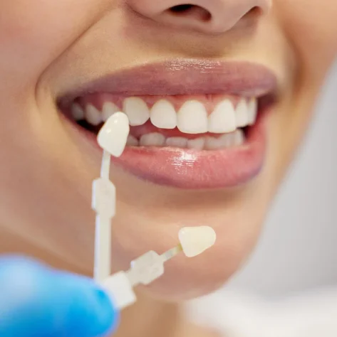 Veneers