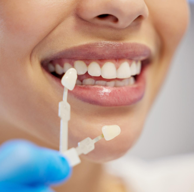 Veneers