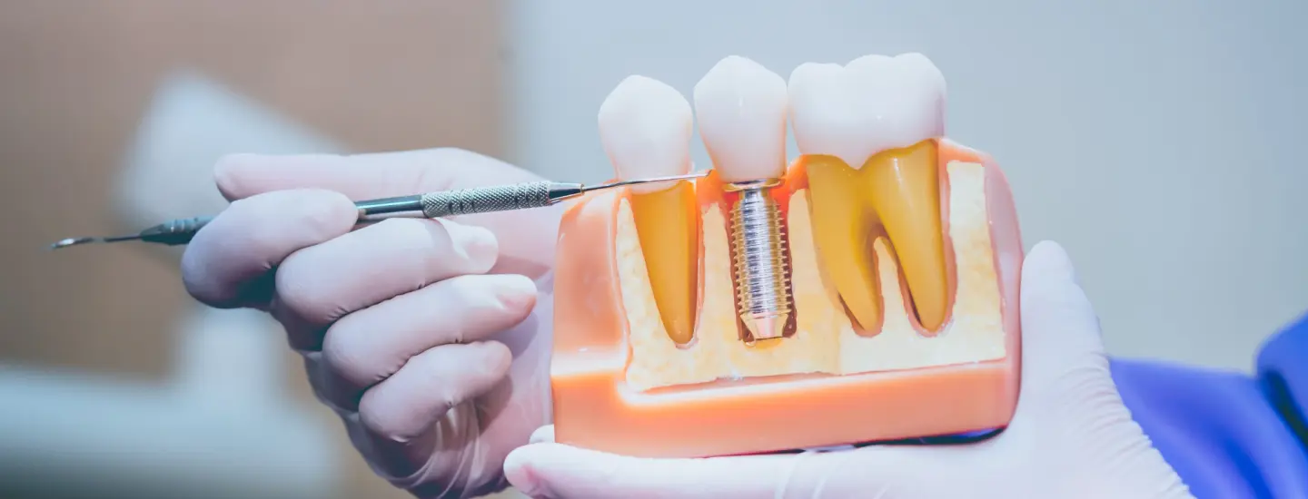 Dental Implants: The Best Solution for Missing Teeth
