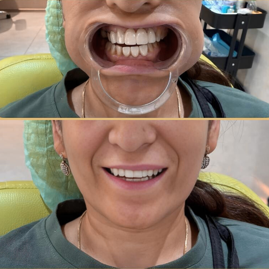 Complete Smile Transformation with Aesthetic Harmony