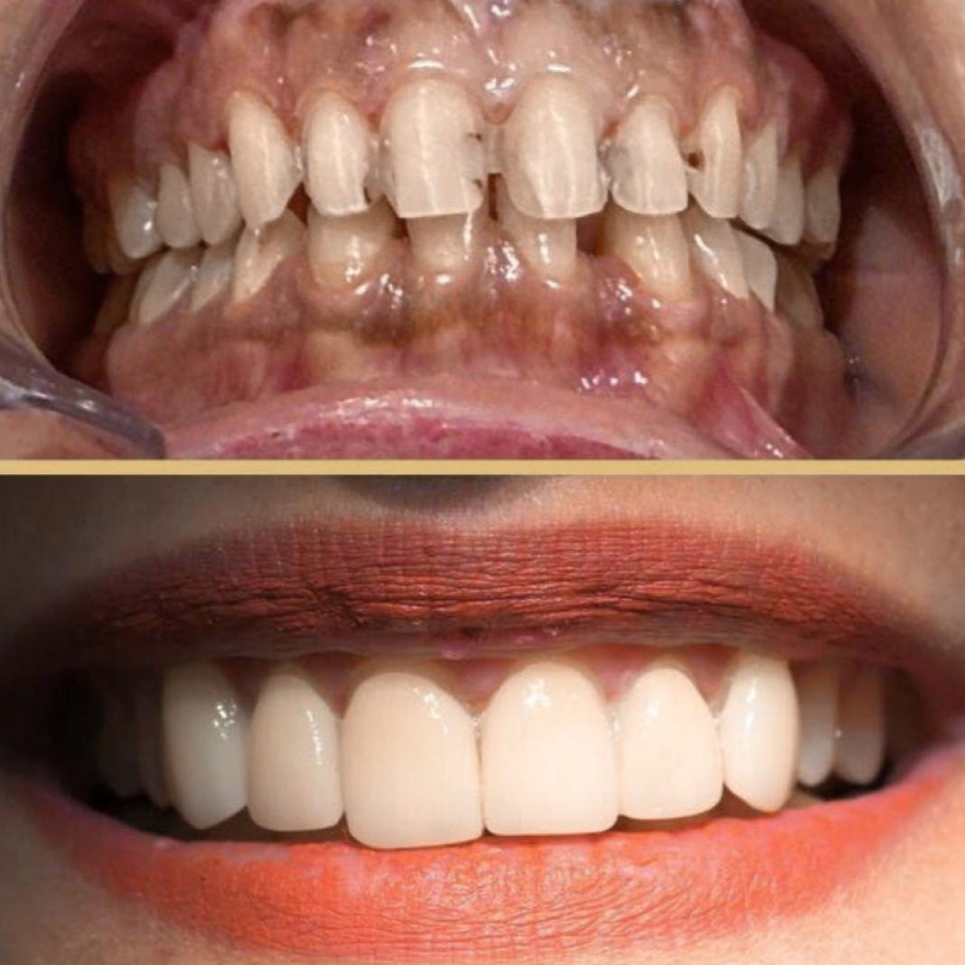 Advanced Smile Makeover with Natural Aesthetic Enhancement