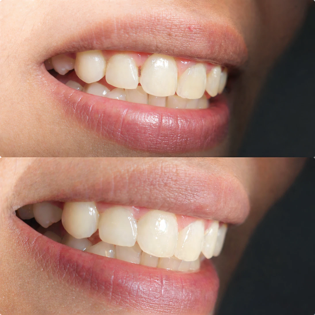 Anterior Aesthetic Correction with Composite Bonding