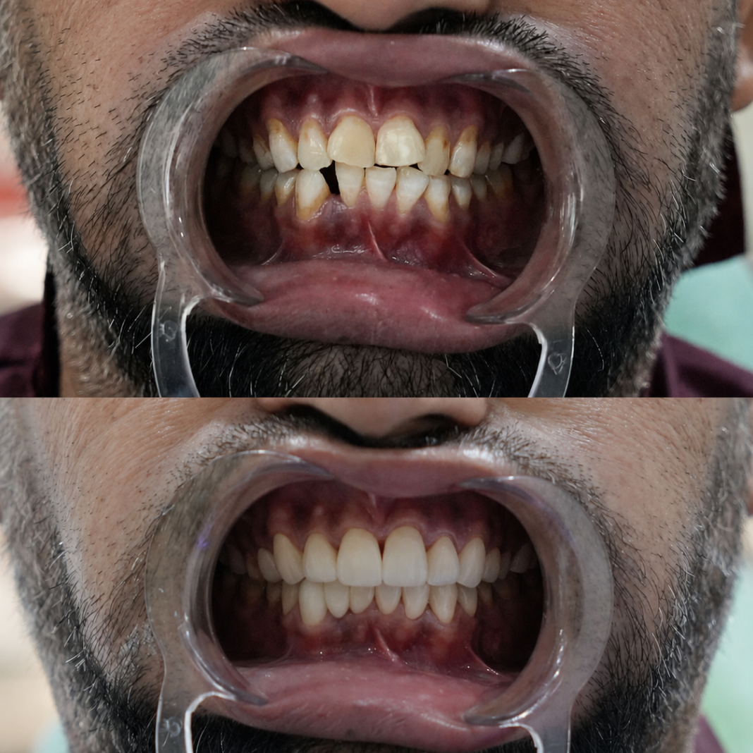 Comprehensive Dental Rehabilitation with Functional & Aesthetic Restoration