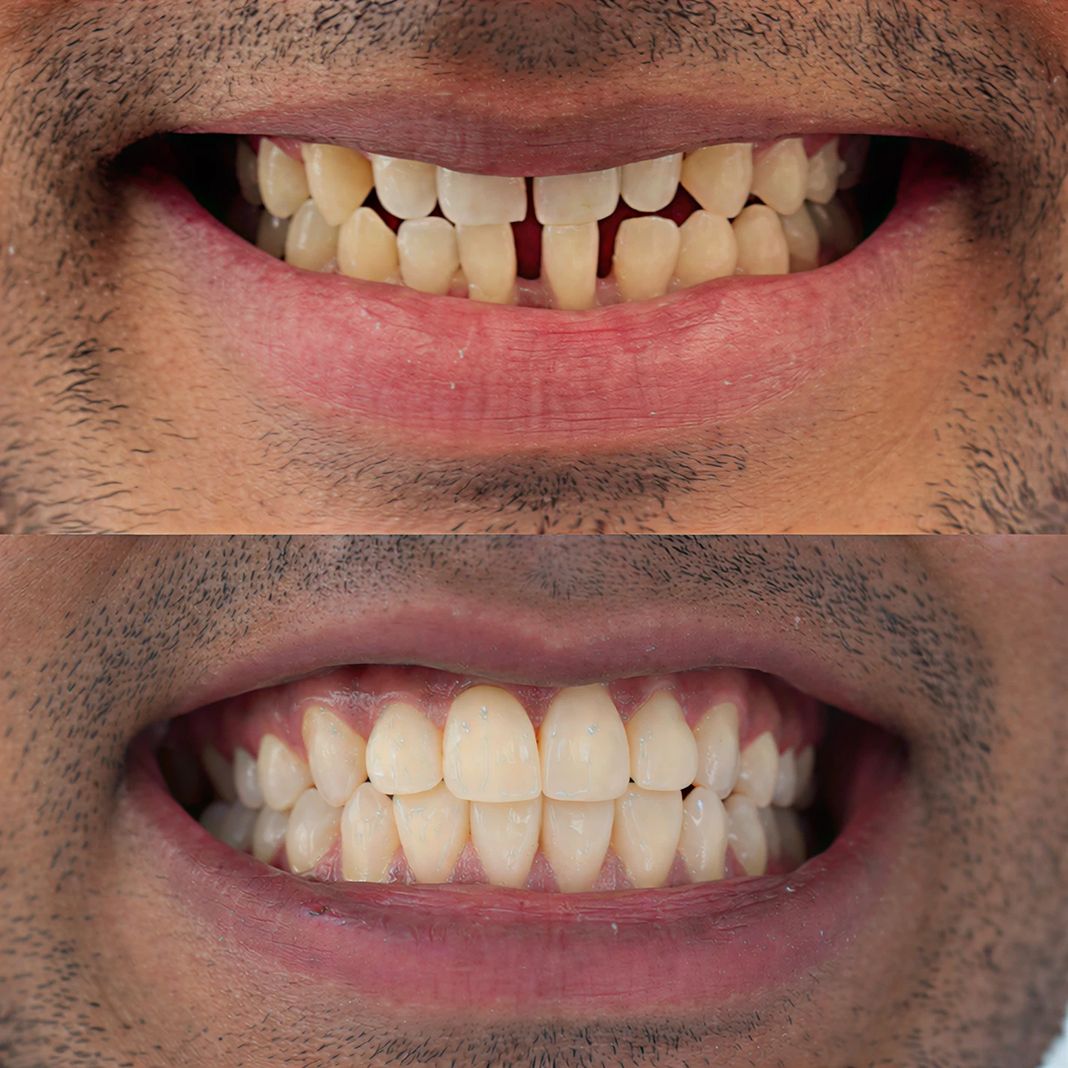 Anterior Smile Enhancement with Composite Build-Up