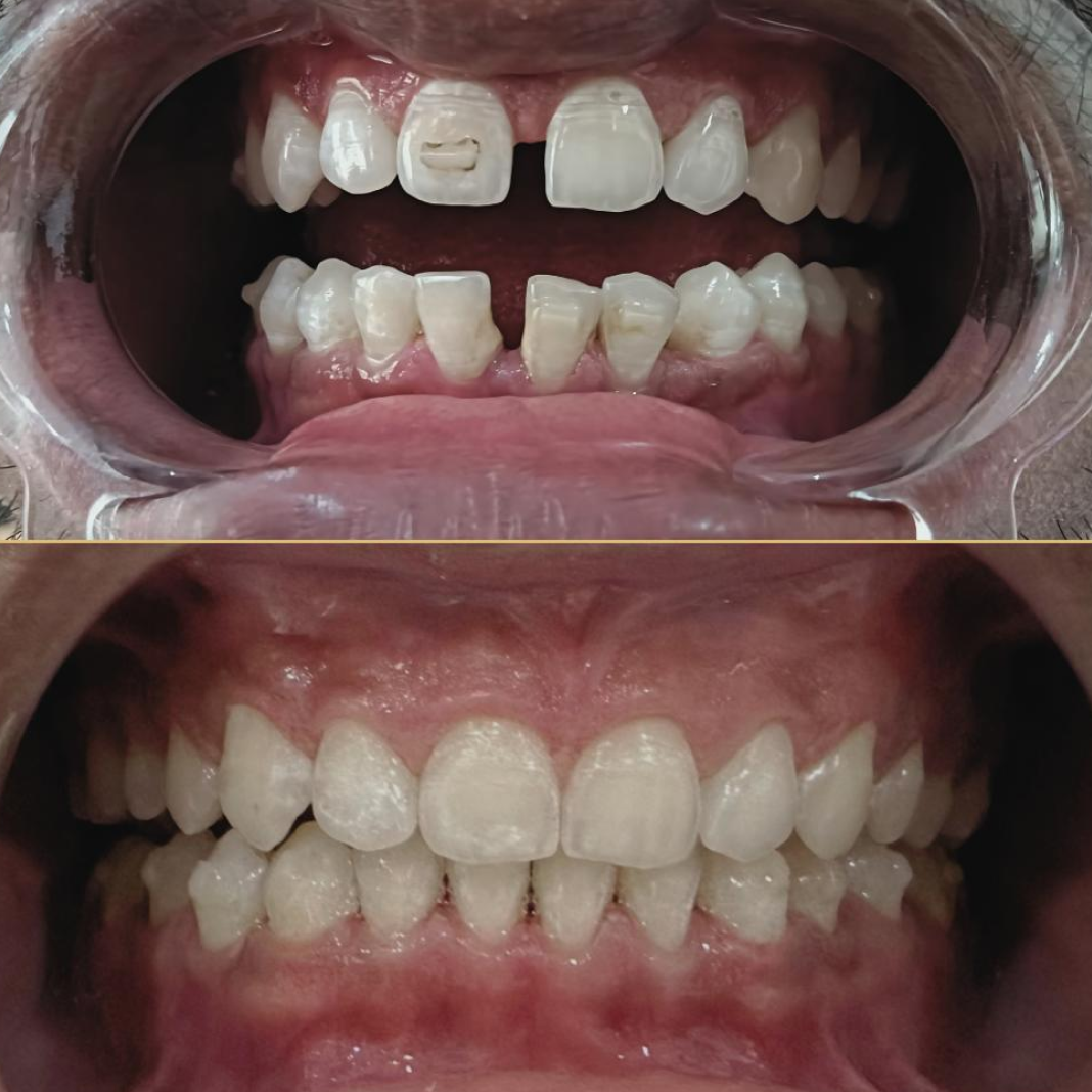 Comprehensive Smile Rehabilitation with Composite Bonding
